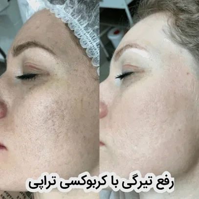 رفع تیرگی و پف زیر چشم با کربوکسی تراپی + مراحل و مزایا